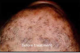 ingrown hair before chin